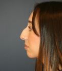 Feel Beautiful - Rhinoplasty 222 - Before Photo